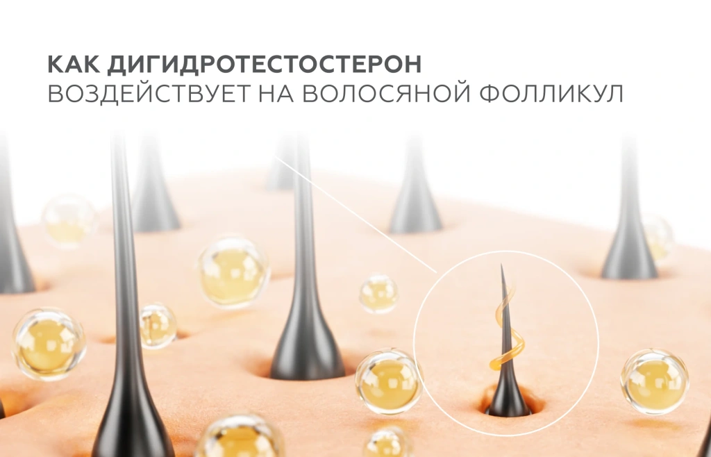 Миниатюризация волосяного фолликула при андрогенетической алопеции под воздействием дигидротестостерона (ДГТ)