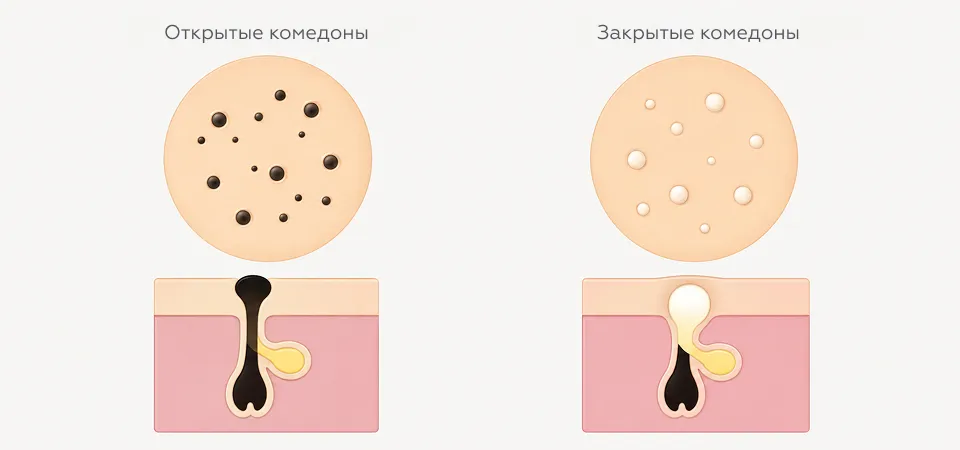 Чем открытые комедоны отличаются от закрытых на схеме кожи