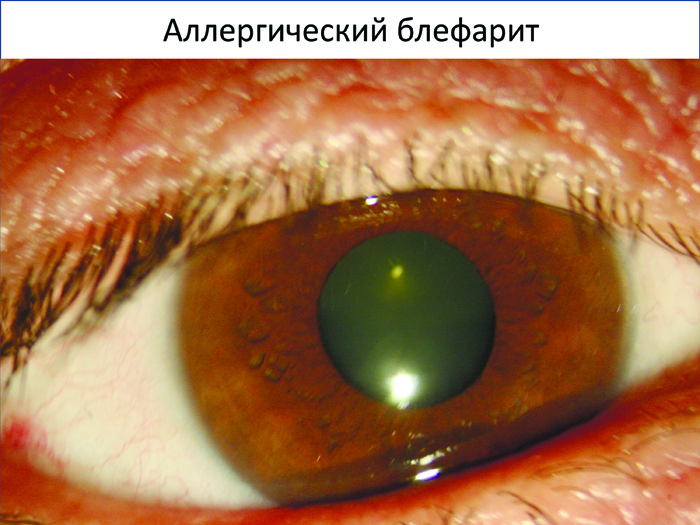 Аллергический блефарит.jpg